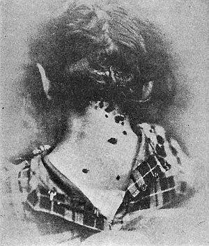 66. Pediculosis of the head. The illustration shows the
characteristic indications of the presence of lice, viz:
the occipital eczema gluing the hairs together, the
swollen cervical glands, and the porrigo, or eruption
of contagious pustules upon the neck. After
Fox.